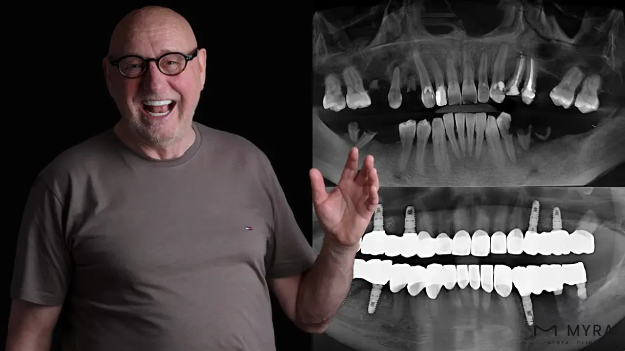 What are the Dental Assessments Before an Immediate Load Implant_-1.webp